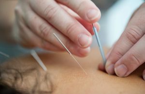 Dry Needling: A Comprehensive Guide by Dr. Khalsa